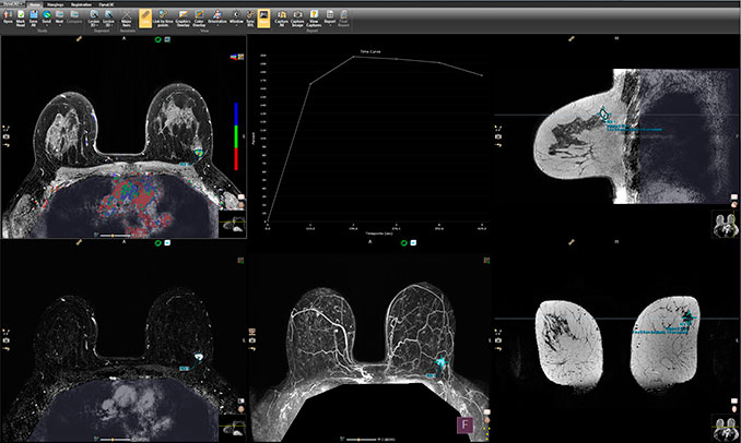 DynaCad MRI post processing voor neuro, prostaat en borst