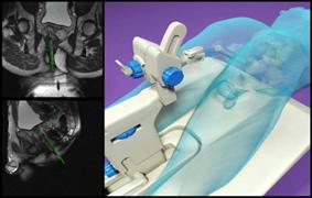 DynaTrim MRI Guided prostate biopsy