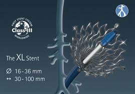 Sinus-XL stent, de groot kaliber stent